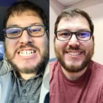 Smilefullness Ortodoncia Invisible Invisalign